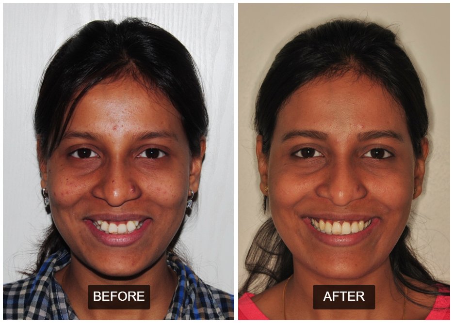 Case 7: Composite Bonding