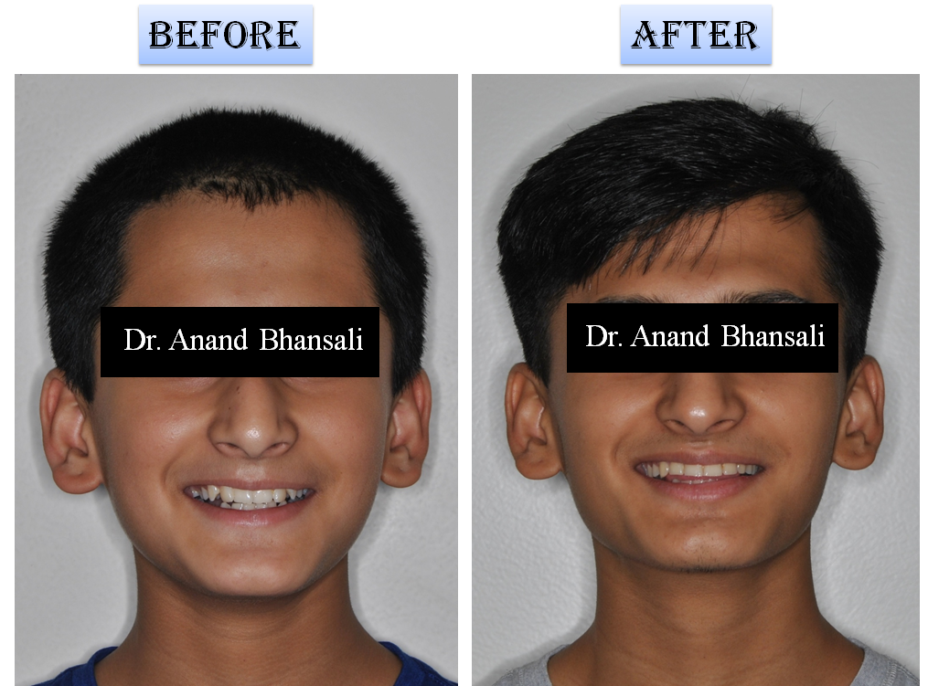 Case 9: Pediatric Smile Correction