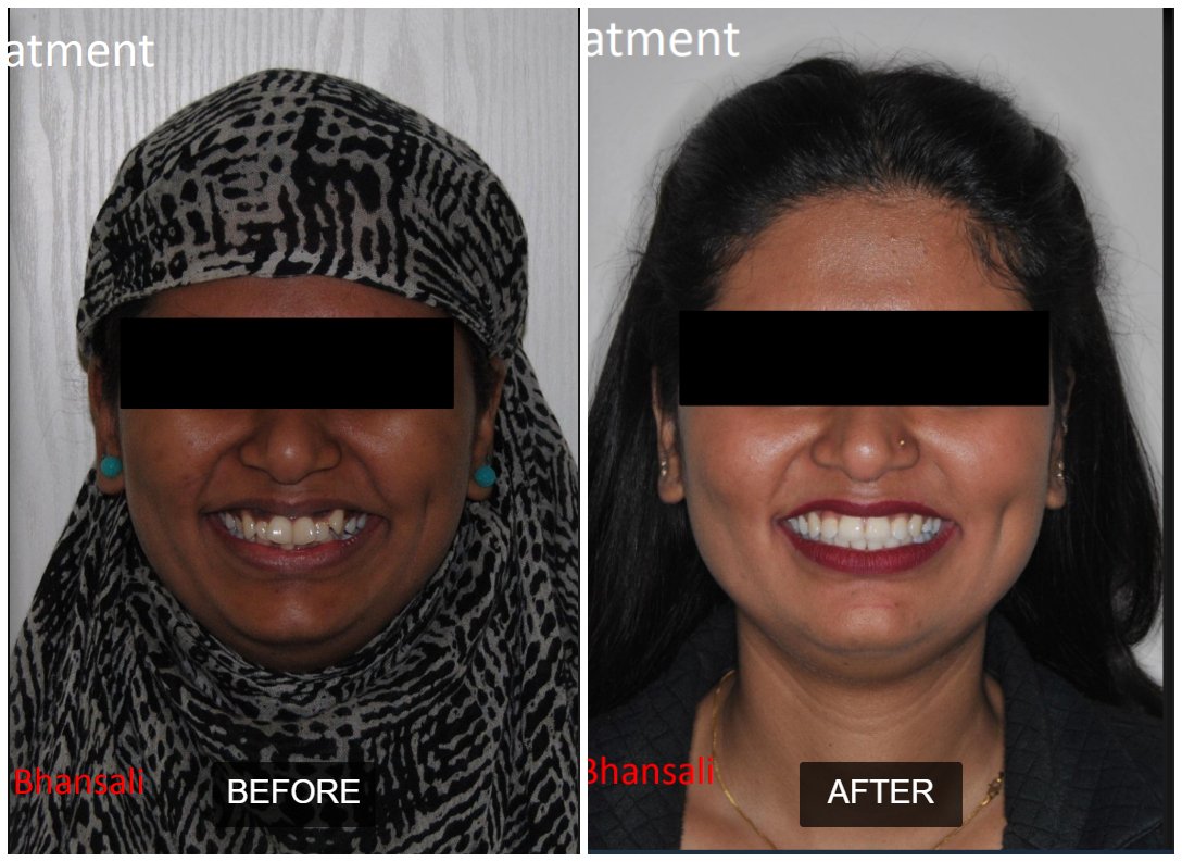 Case 3: Dental Implants