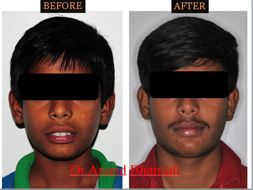 Case 11: Zirconia Crowns