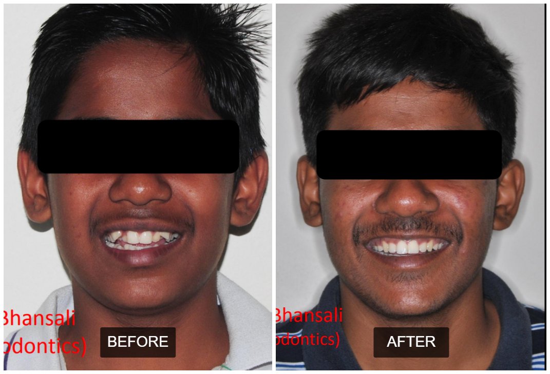 Case 2: Invisalign Clear Aligners