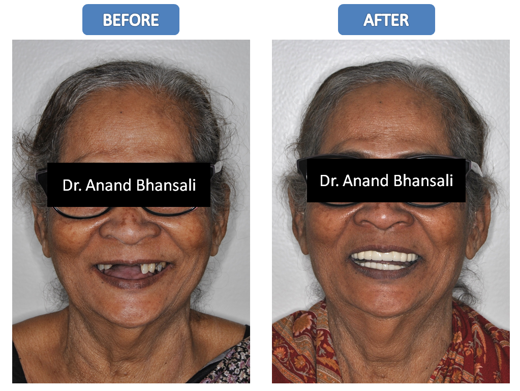 Case 5: Smile Designing